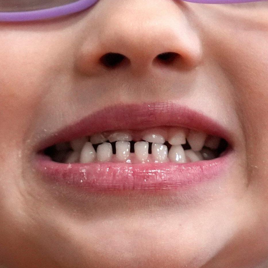 FDA restricts use of kids' fluoride supplements citing emerging health risks